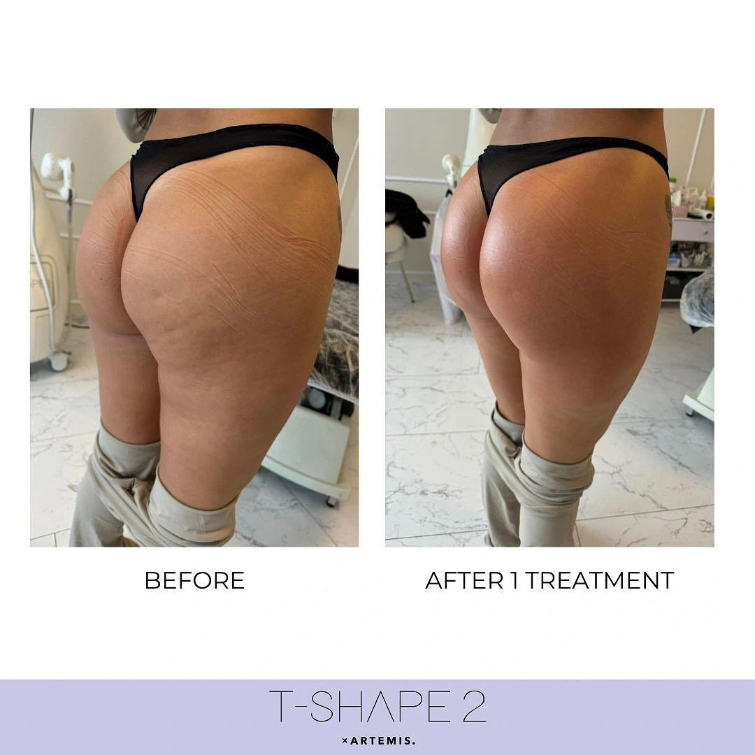 T-shape image two Allure Medical Aesthetics In Thousand Oaks, CA